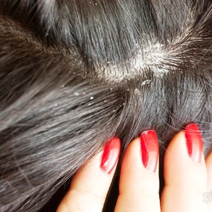 الظروف الجوية التالية تزيد من القشرة في الشعر 