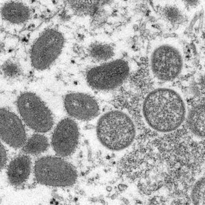 The UAE announces the first case of monkeypox