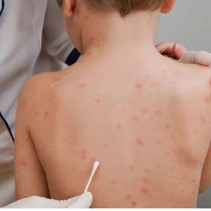 Has monkeypox reached Arab countries?
