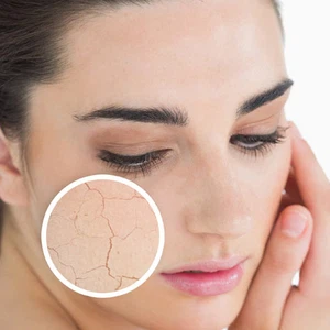 جفاف البشرة في الشتاء.. 10 نصائح وحلول