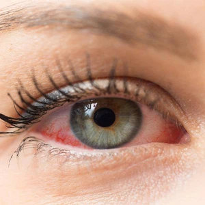 The effect of weather changes on dry eyes