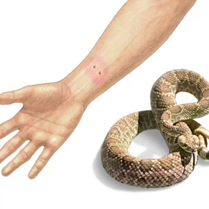 Snake bite.. How do you survive it?