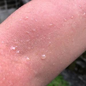 What is water sensitivity? How is it diagnosed and treated? | ArabiaWeather | ArabiaWeather What is water sensitivity? How is it diagnosed and treated? | ArabiaWeather | ArabiaWeather