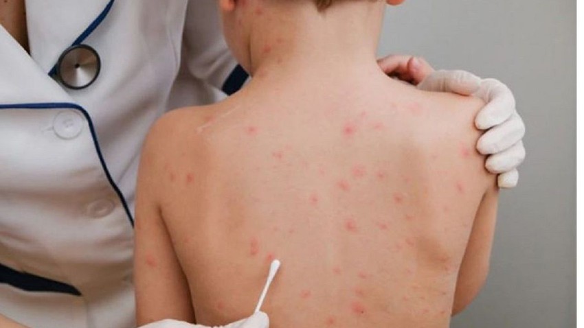 Pays arabes qui ont signalé des cas de « monkeypox »