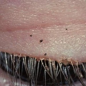 طبيب يعثر على 20 قملة في عين امرأة صينية