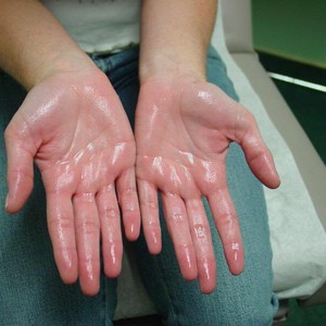 فرط التعرق في اليدين والقدمين والوجه وتحت الإبط 