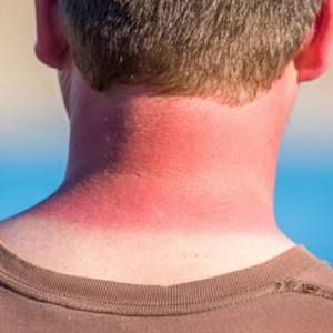 كيف تعالج حروق الشمس في فصل الصيف