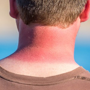 نصائح لعلاج حروق الشمس في فصل الصيف