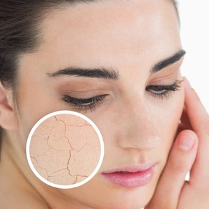 جفاف البشرة في الشتاء.. 10 نصائح وحلول