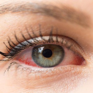 تأثير تغيرات الطقس على جفاف العين 