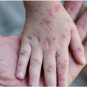 تسجيل أول إصابة بمرض جدري القردة في الأردن