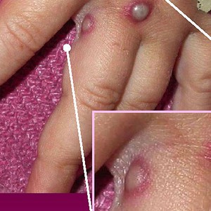 الصحة العالمية تنهي حالة الطوارئ الخاصة بـ "جدري القرود"