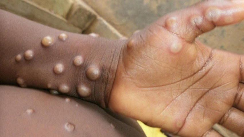 Arabie Saoudite | Le ministère de la Santé annonce officiellement l&#39;enregistrement du premier cas de monkeypox à Riyad. Détails