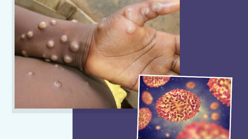 Après la `rare` épidémie de la maladie dans certains pays, que savons-nous du monkeypox ?