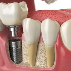 د. سامر المبروك  اختصاصي جراحة الفم و الفكين و زراعة الأسنان